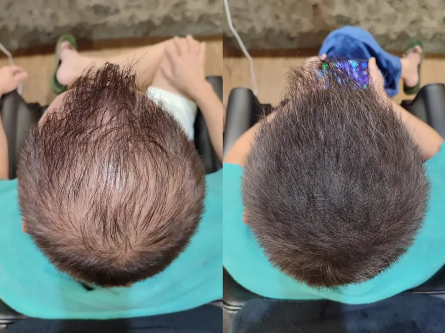 Before and after 1 session, photo 5