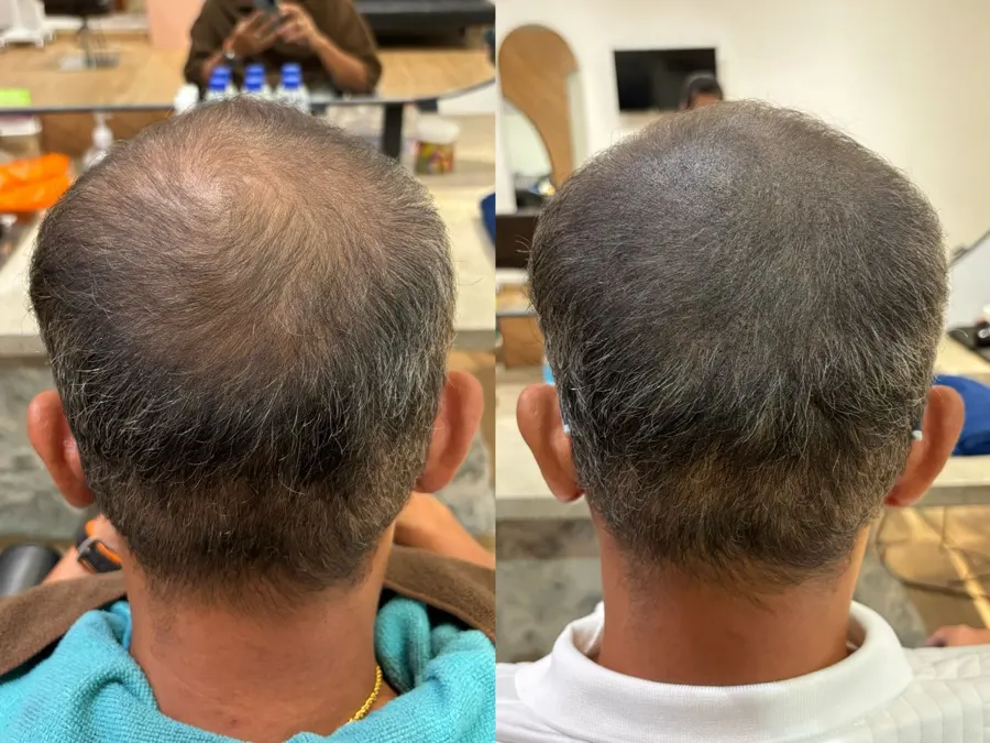 Before and after 1 session, photo 9